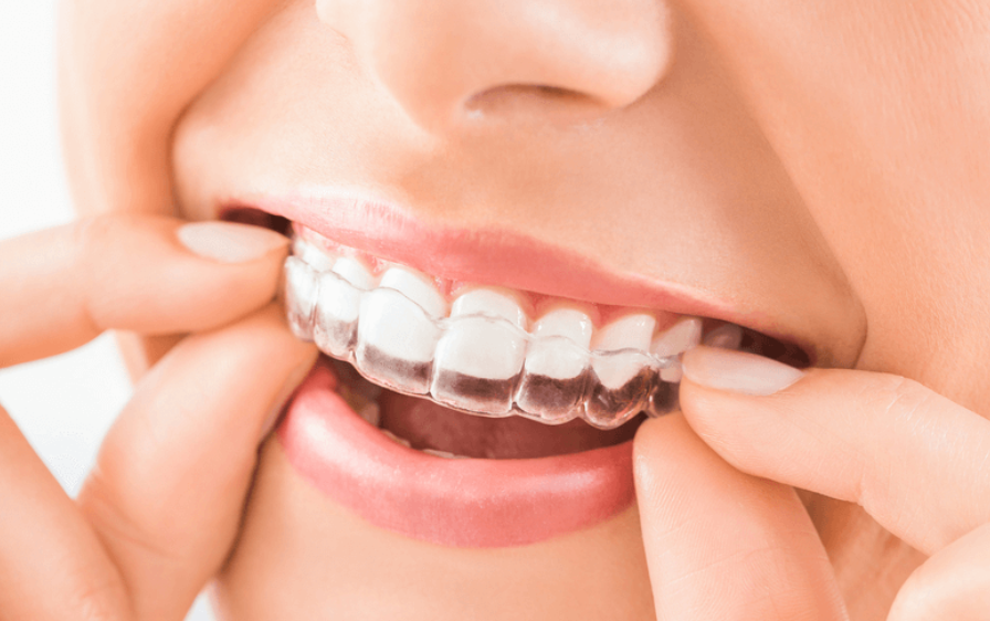 Top 7 cách làm trắng răng sau một đêm cực đơn giản