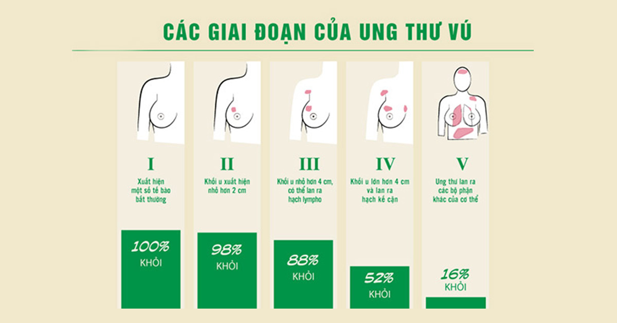 Dấu hiệu ung thư vú ở phụ nữ