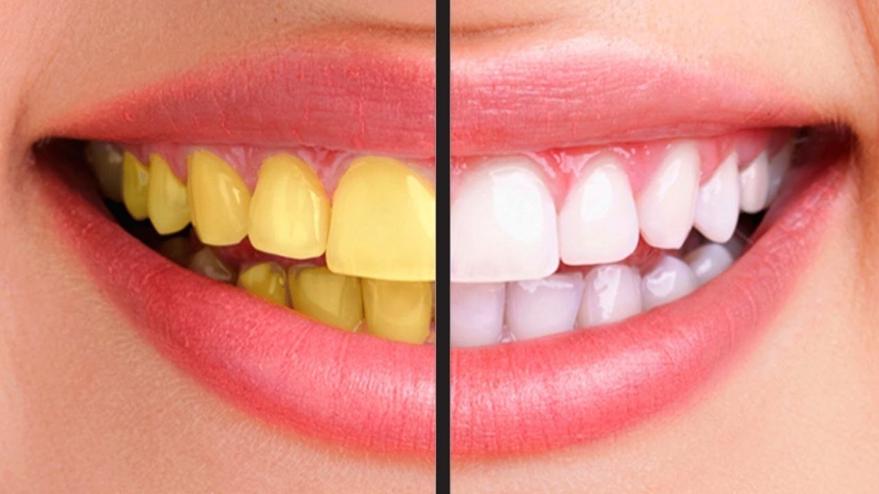 Cách làm răng trắng có khó không? Chia sẻ các bí quyết thực hiện đơn giản nhất